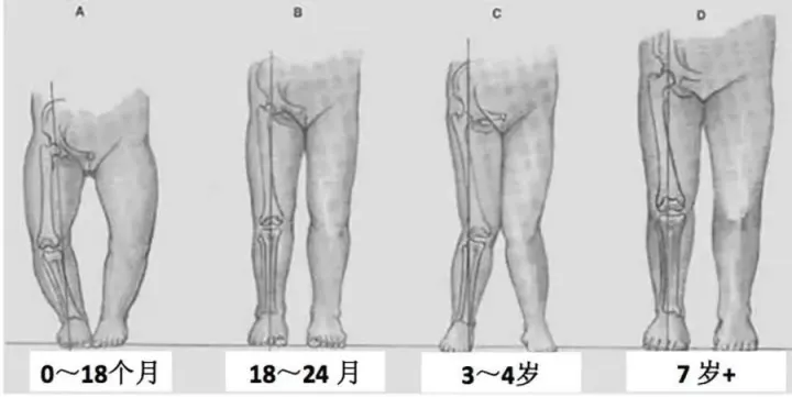 童谣四季科普:纸尿裤真的会导致宝宝"罗圈腿"吗?